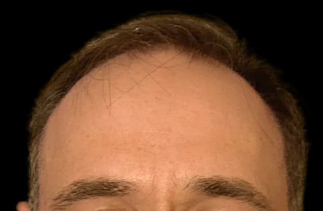 Reconstrução da linha frontal — FUE — frente, antes