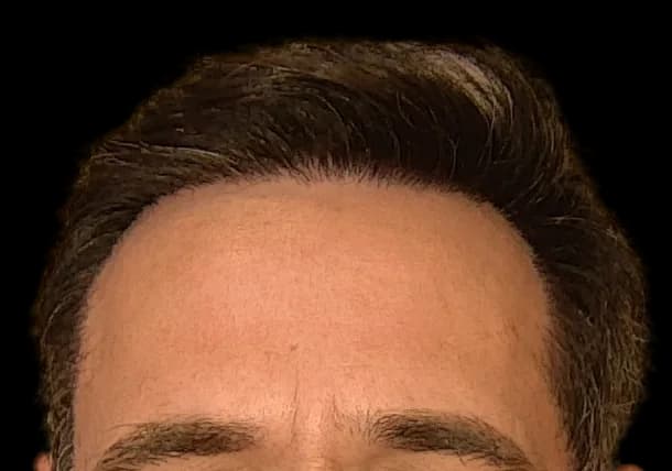 Reconstrução da linha frontal — FUE — frente, depois