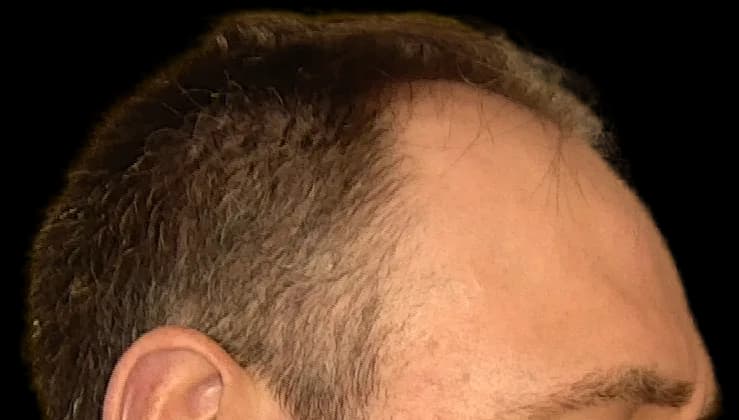 Reconstrução da linha frontal — FUE — perfil, antes
