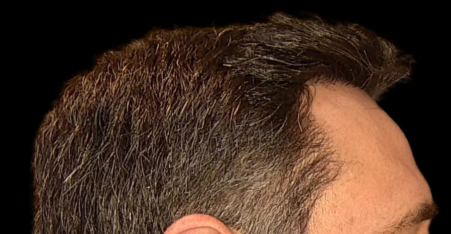 Reconstrução da linha frontal — FUE — perfil, depois