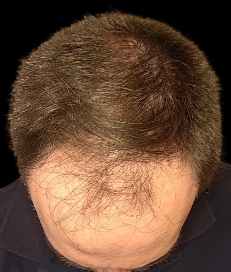 Reconstrução da linha frontal — FUE — topo, antes