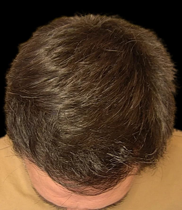 Reconstrução da linha frontal — FUE — topo, depois