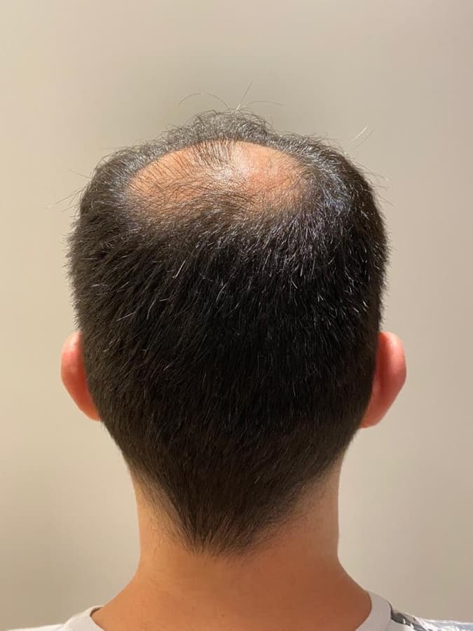 Preenchimento da coroa — FUE — coroa, antes