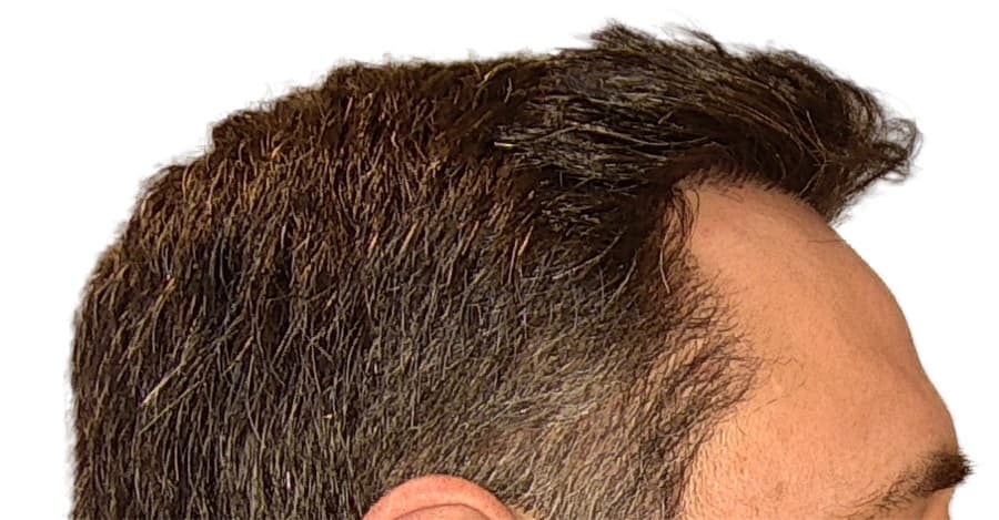Mesmo caso — vista de perfil — depois