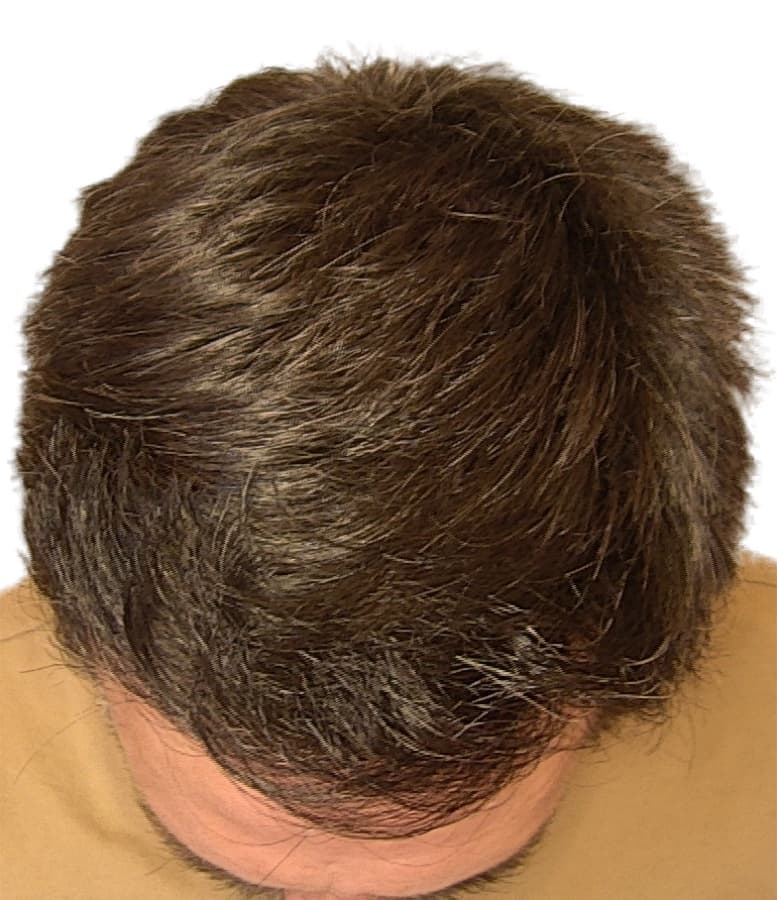 Recuperação da linha frontal — vista de topo — depois