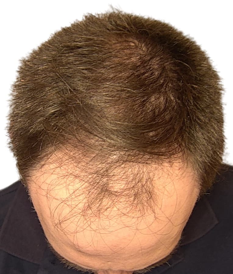 Recuperação da linha frontal — vista de topo — antes